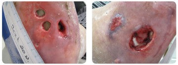 Diabetic foot ulcer pictures