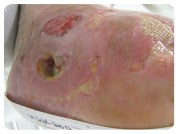 Diabetic foot ulcer picture