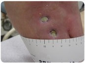 Healing diabetic foot ulcer