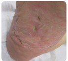 Healed diabetic foot ulcer