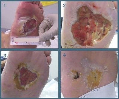 Infected wound pictures