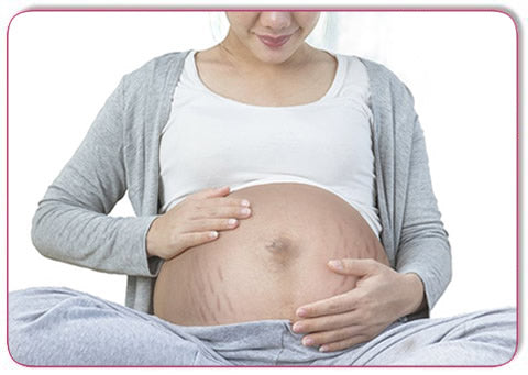 woman during pregnancy with stretch marks