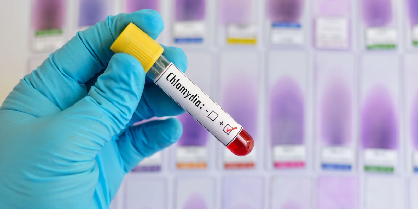 Chlamydia blood test
