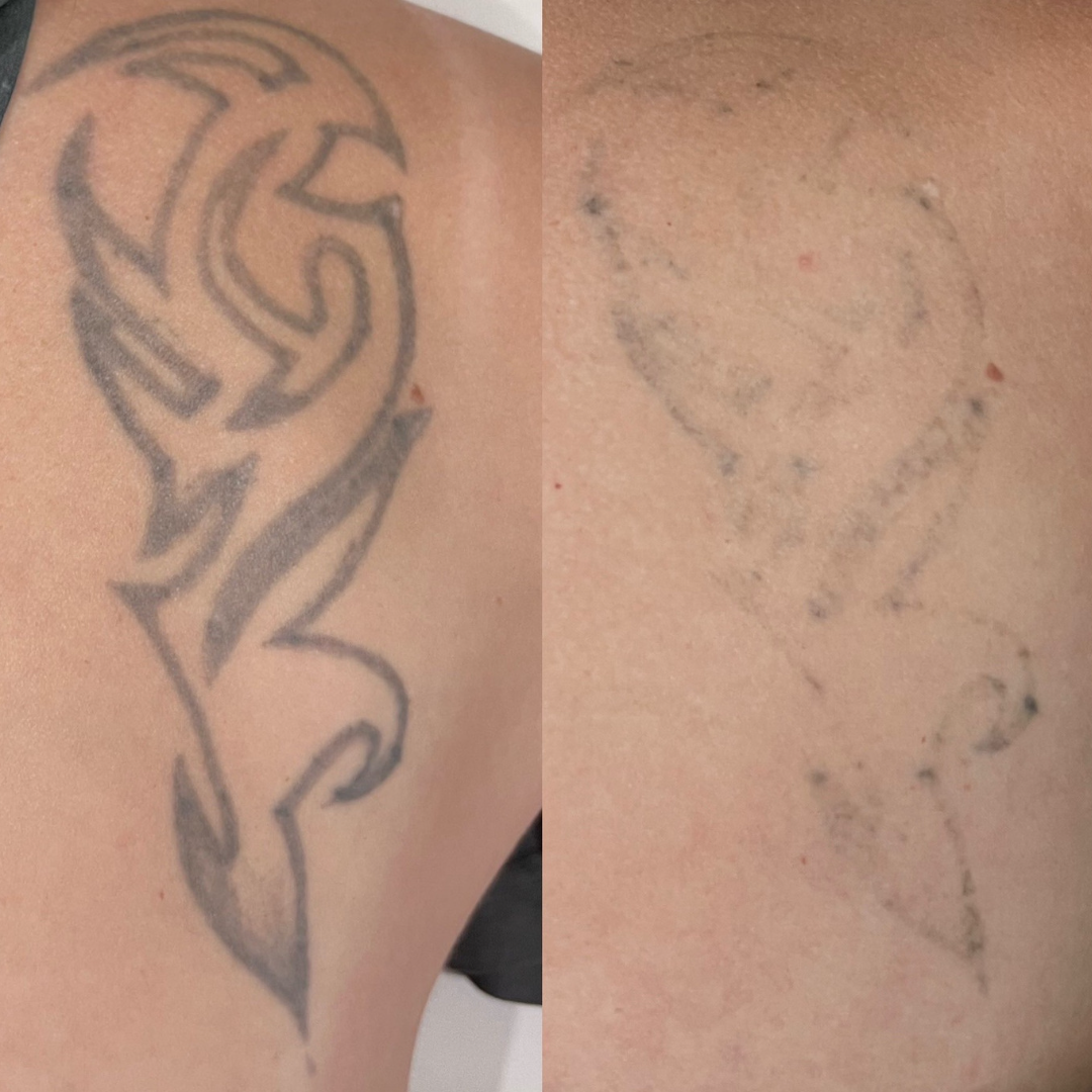 When forever is over hit Delete for full or partial PicoWay laser tattoo  removal This weeks Before  After la  Laser tattoo removal Tattoo  removal Tattoos