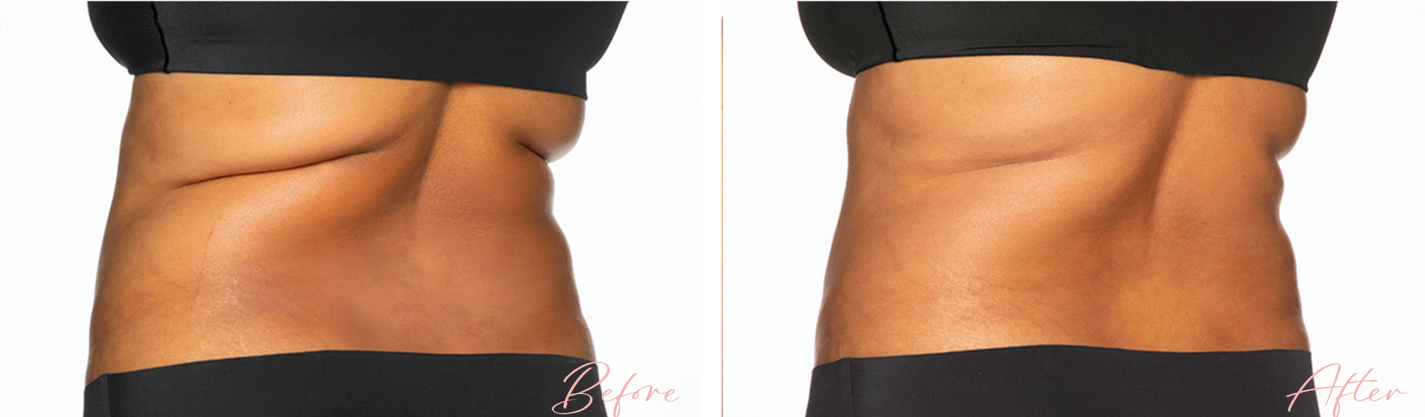 Before and After Cool Sculpting