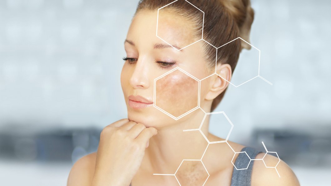 rosacea and hyperpigmentation