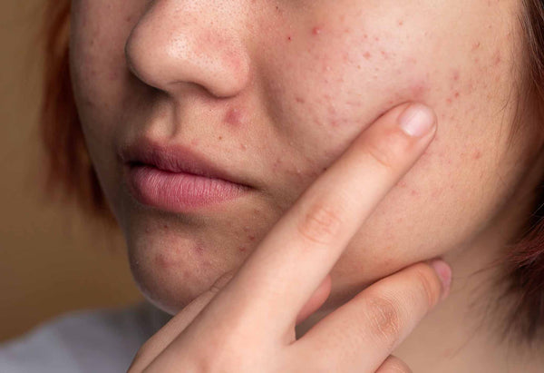 sleep deprivation causes acne