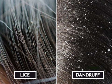 Effective anti-lice and dandruff treatment shampoo with natural ingredients.