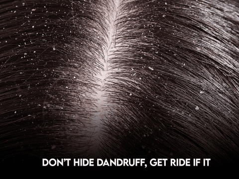 Close-up of a scalp with dandruff, encouraging the use of anti-dandruff solutions.