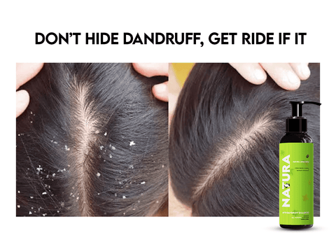 Before and after scalp images showing the effectiveness of Natura anti-dandruff shampoo.