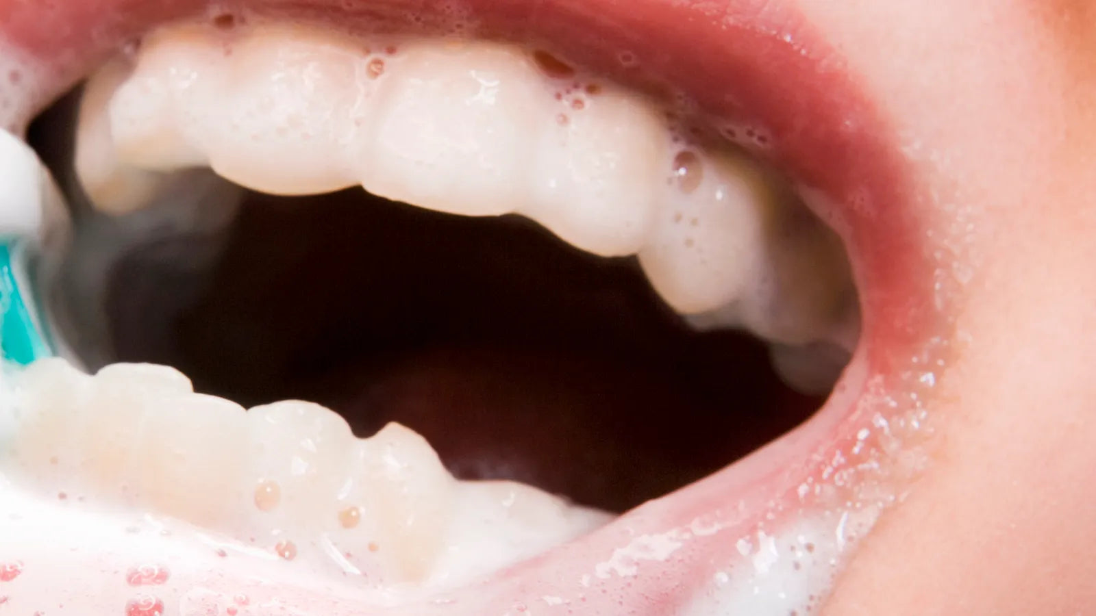 bicarbonate dents