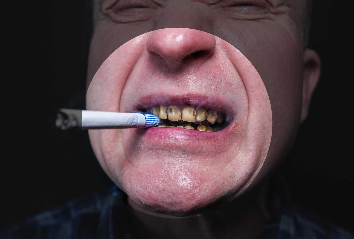 Effet du tabac sur les dents