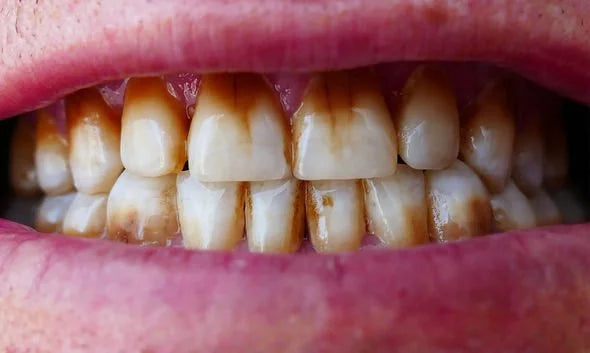 dents marrons