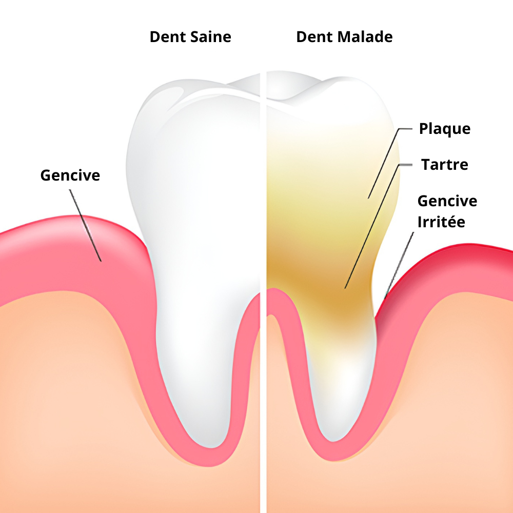 Tartre sur les Dents : Comment s'en Débarrasser ou le Prévenir?