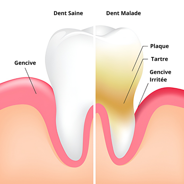 tartre et plaque dentaire