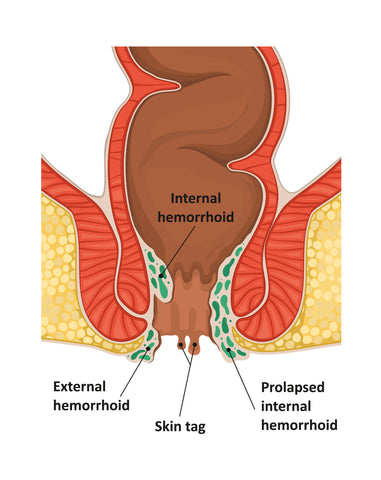 hemorrhoid grades 1 2 3 4 internal external hemorrhoids prolapsed skin tag fissure
