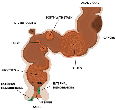 anatomy of the anal canal rectum anus fissure hemorrhoids polyp proctitis diverticulitis stalk cancer