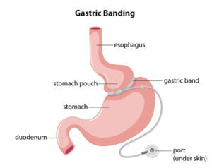 bariatric surgery for diabetes