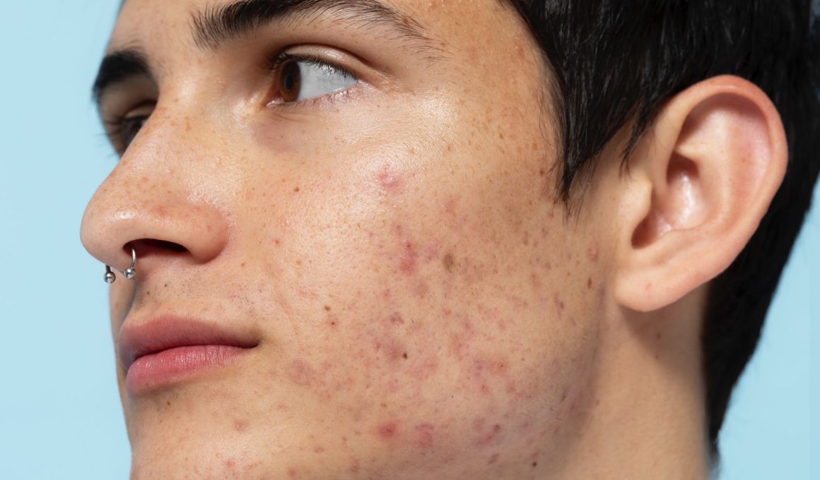 Come-eliminare-acne-1160x680.jpg__PID:ef923205-39e9-42e9-aa56-1796c04322ca