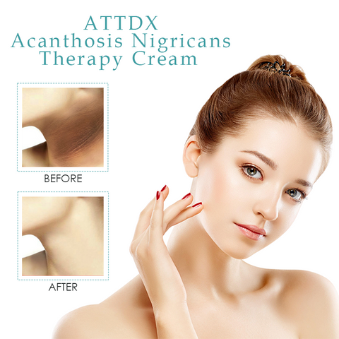 ATTDX Acanthosis NigricansTherapy Cream