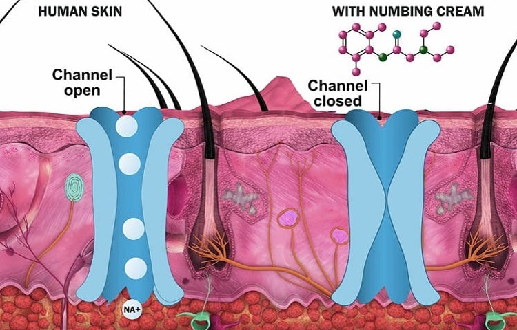 What is Numbing Cream
