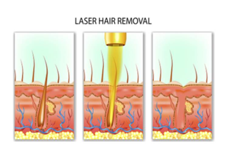 Laser Hair Removal