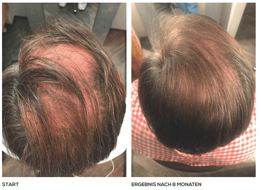 Hereditary Baldness  How It Can Be Treated  By Hairline International   Lybrate