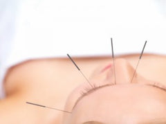 Needle acupuncture therapy. The Seaweed Bath Co.