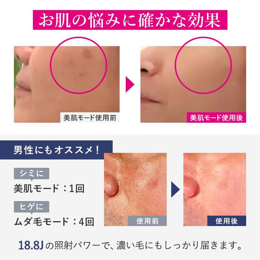 [2022年モデル] STELLA BEAUTE IPL 光美容器（ステラボーテ）