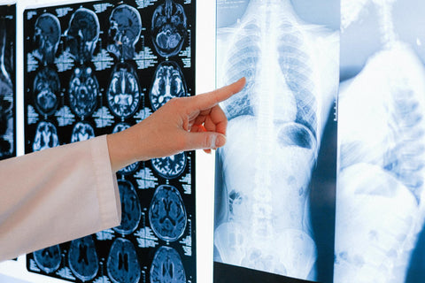 Un médecin montre un scanner montrant un cancer du poumon