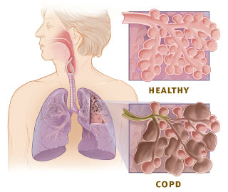 Diagram of healthy lungs vs lungs with COPD