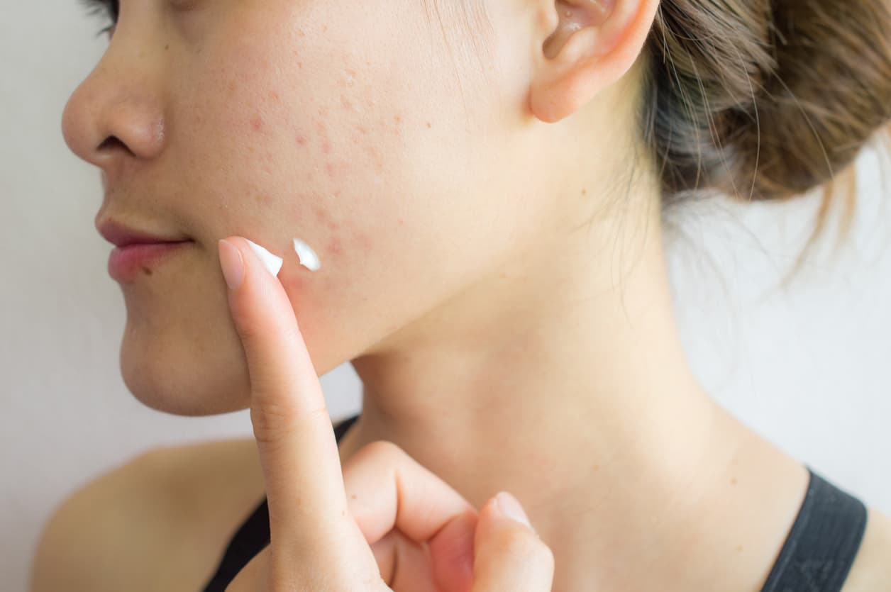 woman applying acne cream
