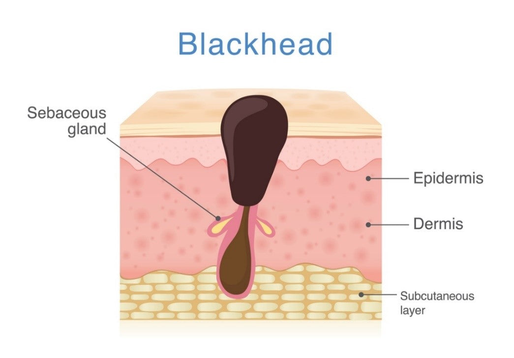 blackhead diagram