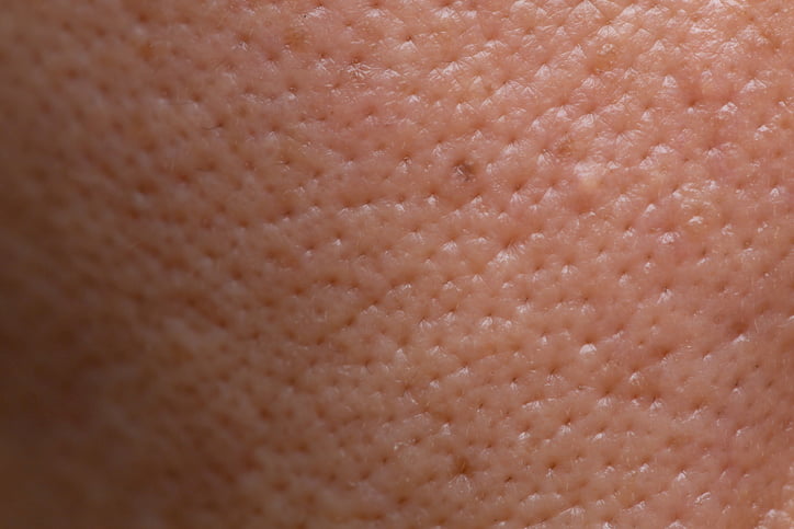 enlarged pores