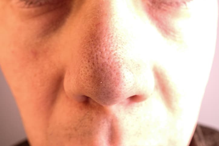 enlarged nose pores