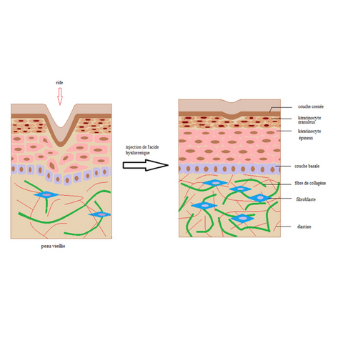 injection acide hyaluronique