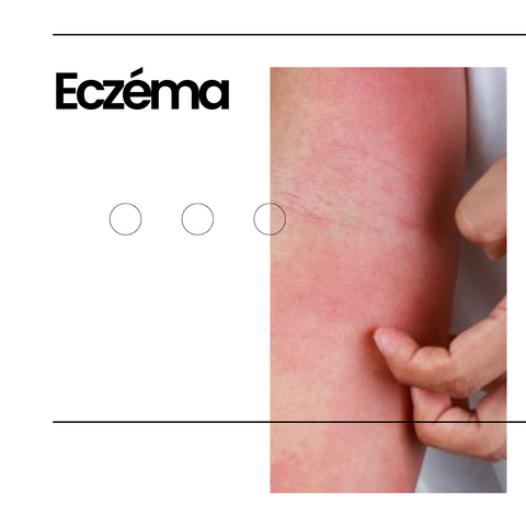 eczema