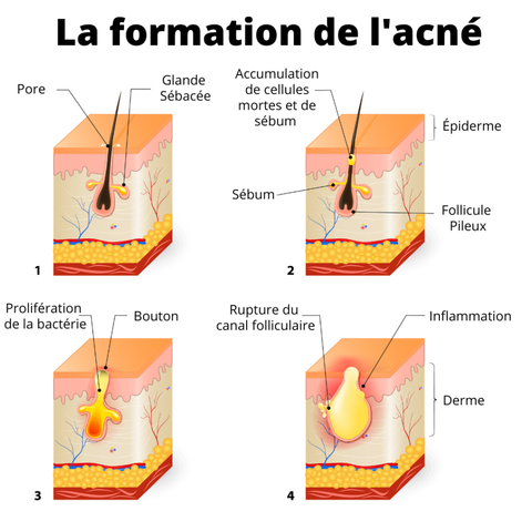 formation de l'acné