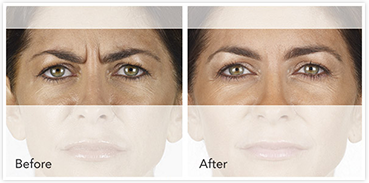 Xeomin before & after