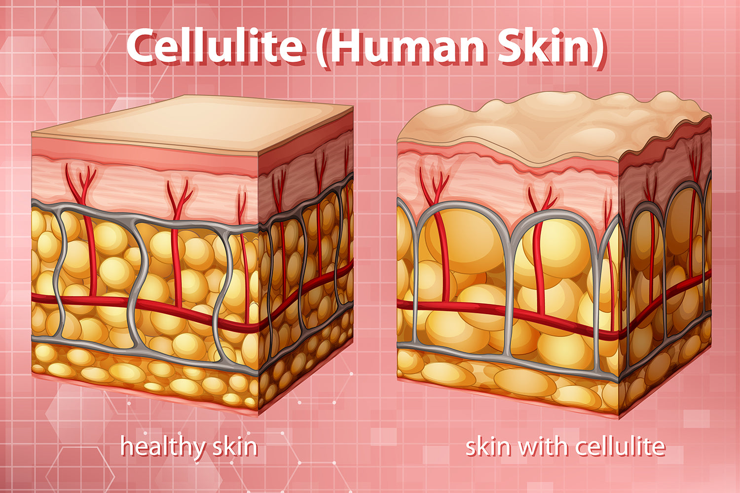 does red light therapy help cellulite