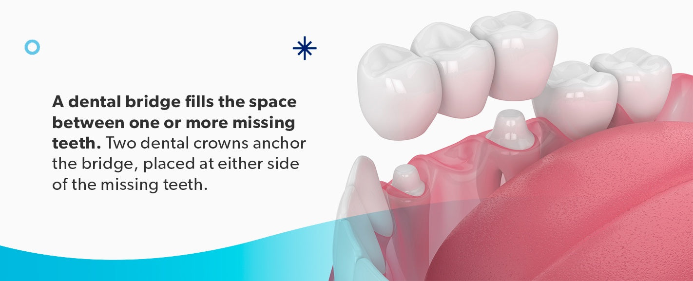 A dental bridge fills the space between one or more missing teeth.