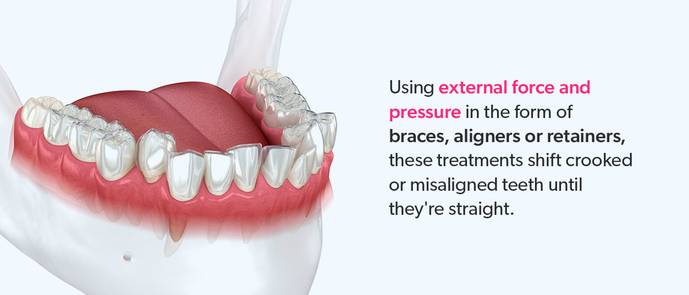Braces, aligners and retainer treatments use external force and pressure to shift teeth.