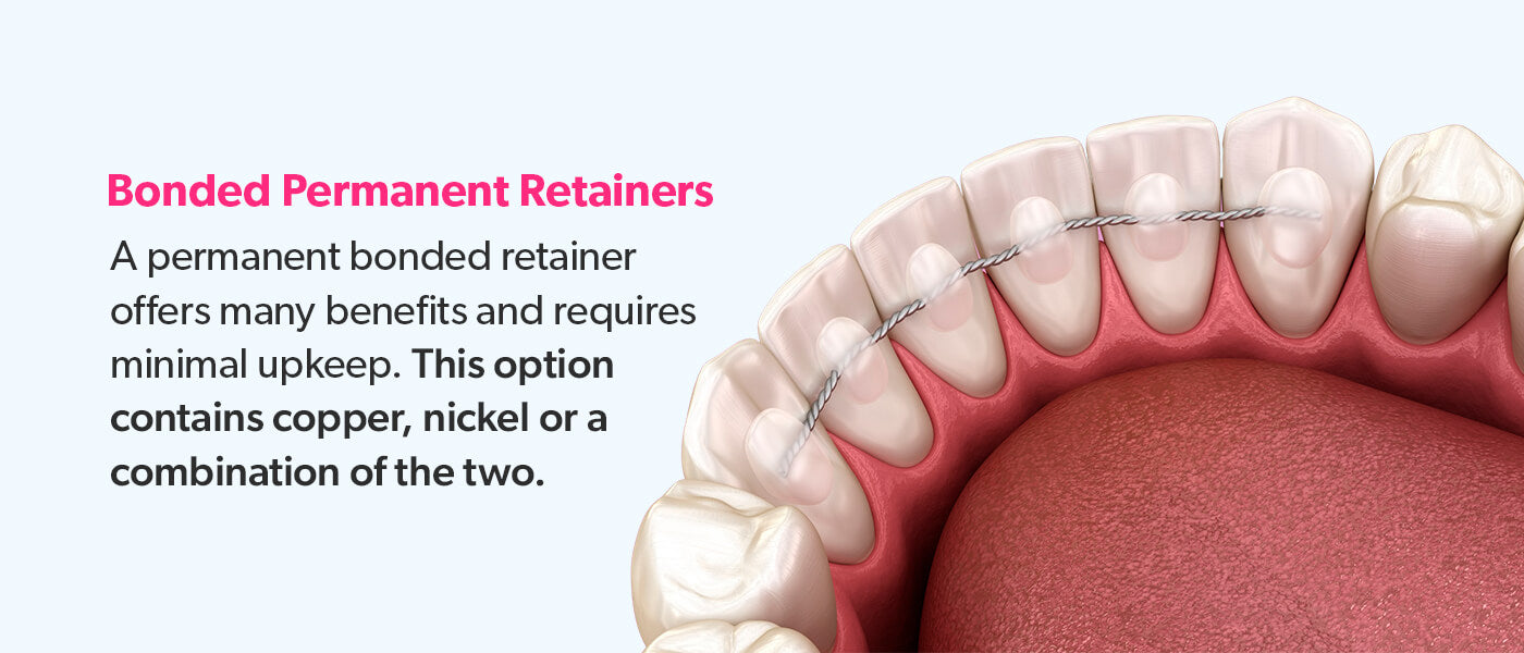 Bonded Permanent Retainers