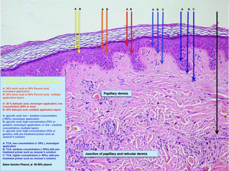 chemo exfoliation 