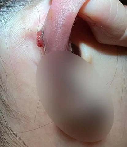 a side view of an ear piercing bump that has developed for a couple of days