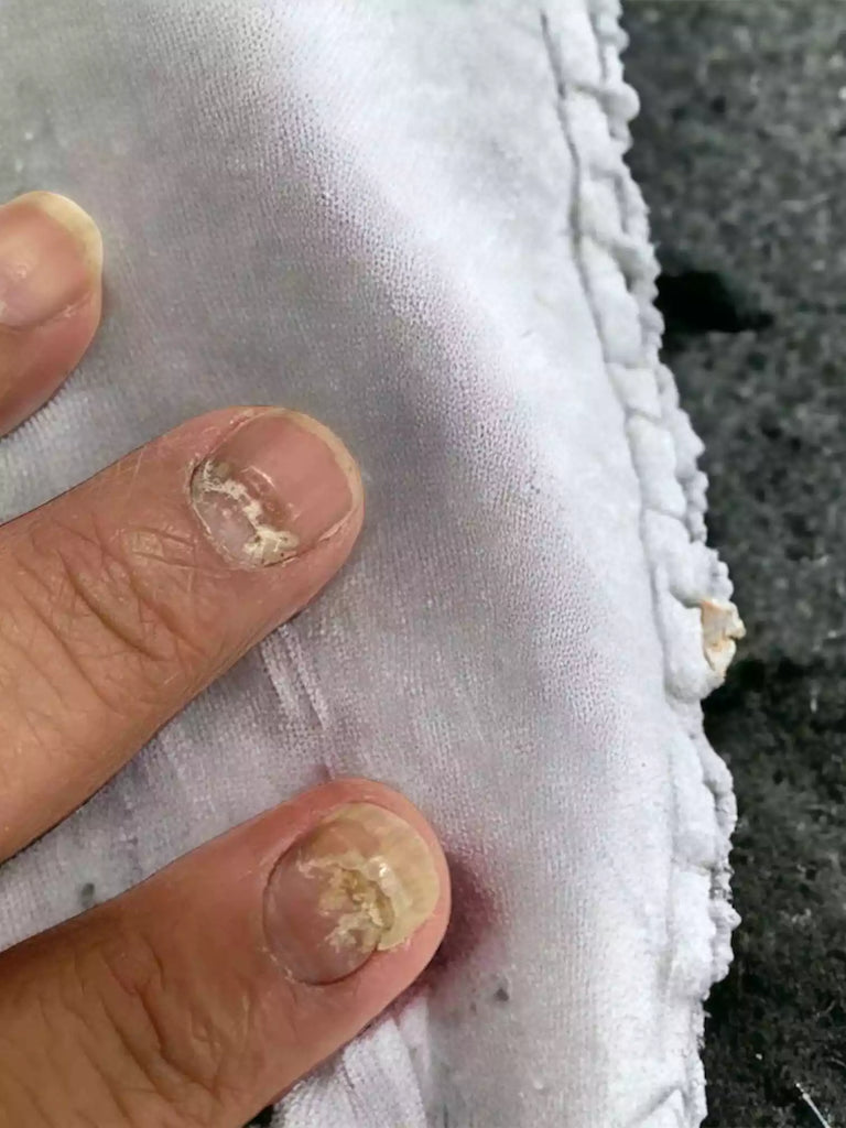 Infection des ongles