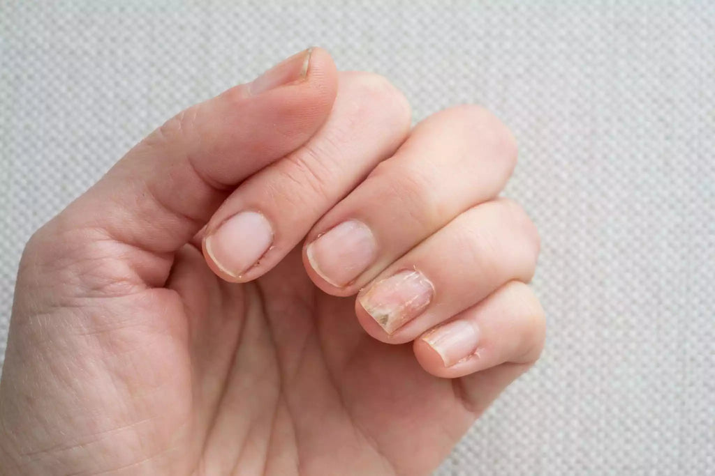 Ongles incarnés