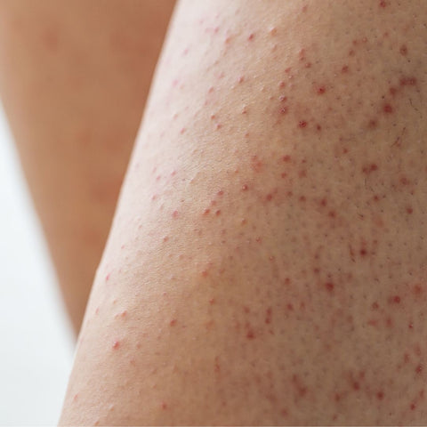 keratosis pilaris on legs