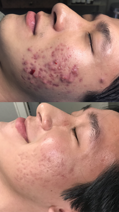 Flesh colored bumps is Non-Inflamed Acne (Your Story).png__PID:eff5c8c3-762b-44c6-9a0d-2f66ebbc0e4b