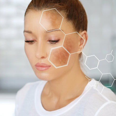 Sunspots and Melasma